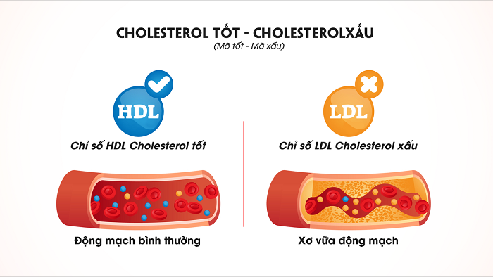Mỡ máu xấu (LDL - Cholesterol)