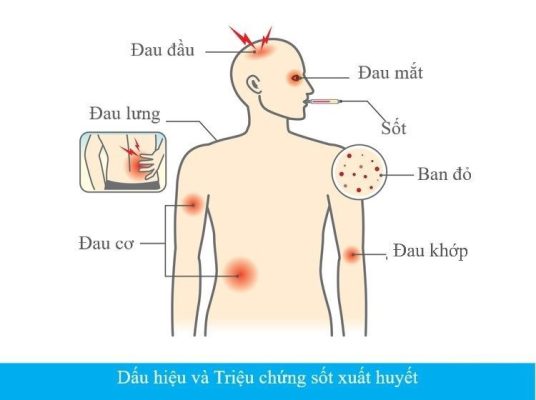 Cảnh báo - sốt xuất huyết Dengue vào mùa