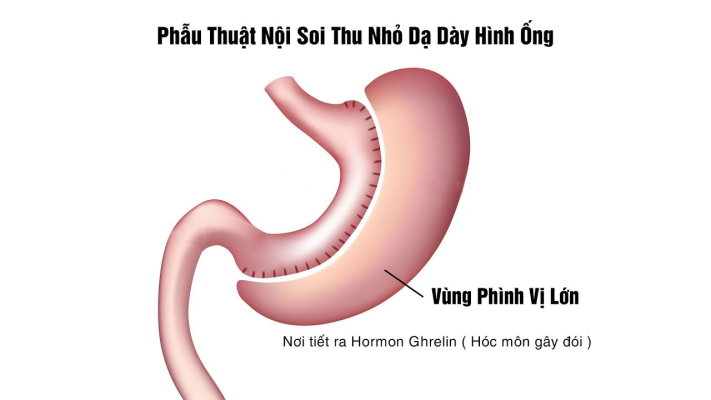 Chia sẻ PGS.BS Nguyễn Anh Tuấn về thu nhỏ dạ dày 