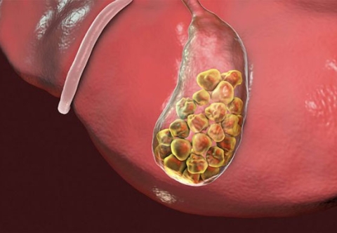 Tổng quan bệnh sỏi túi mật