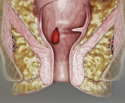 Tổng quan bệnh trĩ 