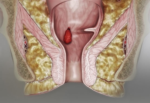 Tổng quan bệnh trĩ 