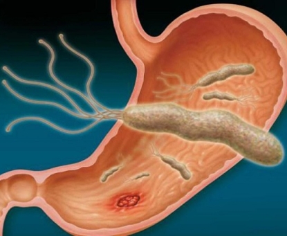 Vi khuẩn HP có gây ung thư dạ dày không?