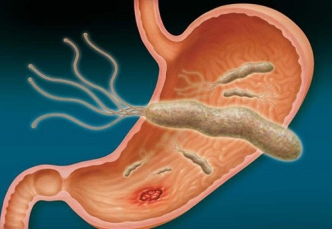 Vi khuẩn HP có gây ung thư dạ dày không?