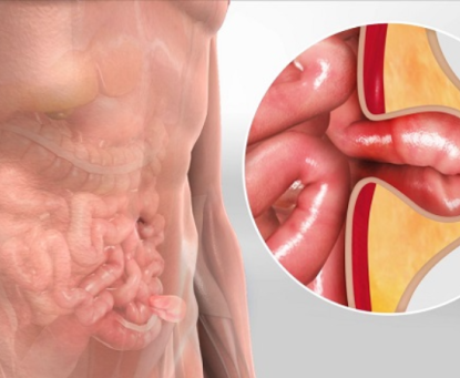 Thoát vị bẹn có bị tái phát sau mổ hay không?