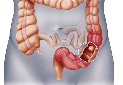 Táo bón và ung thư đại tràng: Mối liên hệ và dấu hiệu cảnh báo