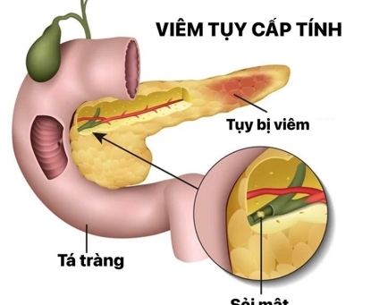 Vì sao sỏi túi mật có thể gây biến chứng viêm tụy cấp, biến chứng có nguy hiểm không?