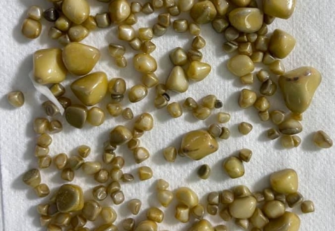 Hơn 100 viên sỏi cứng như đá lấp đầy túi mật