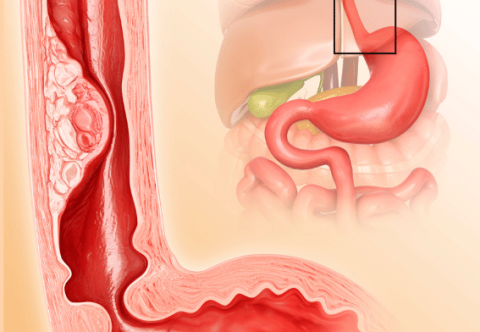 Bệnh Barrett thực quản và mối liên quan với trào ngược dạ dày thực quản