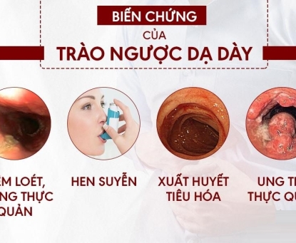 Trào ngược dạ dày thực quản có thể gây biến chứng gì