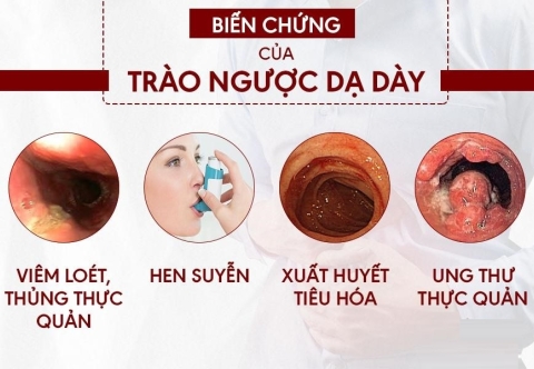 Trào ngược dạ dày thực quản có thể gây biến chứng gì