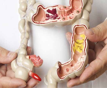 Bệnh trĩ và viêm đại tràng có liên quan không?