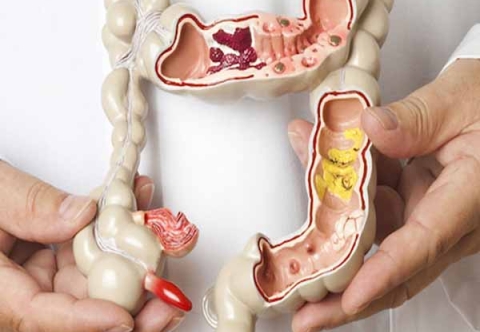 Bệnh trĩ và viêm đại tràng có liên quan không?