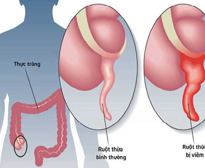 Nhận biết và chẩn đoán bệnh viêm ruột thừa cấp