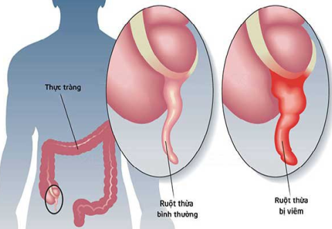 Nhận biết và chẩn đoán bệnh viêm ruột thừa cấp