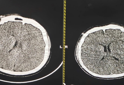 Sử dụng phương pháp kiểm soát thân nhiệt chỉ huy cứu sống nam thanh niên phù não do thắt cổ tự tử