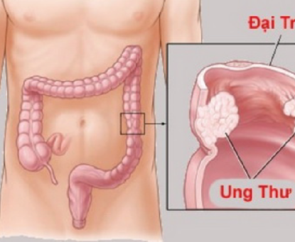 Điều gì có thể làm bạn bị mắc bệnh ung thư đại trực tràng