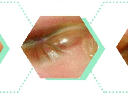 Áp xe hậu môn có tự khỏi không, và cách xử lý ban đầu tại nhà