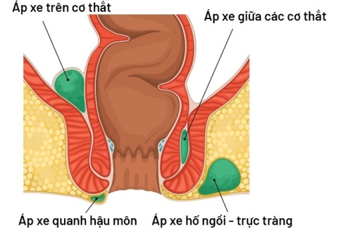 Hướng dẫn chăm sóc sau mổ áp xe hậu môn