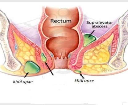 Tổng quan về áp xe hậu môn