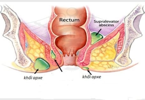 Tổng quan về áp xe hậu môn