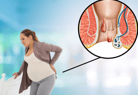 Tại sao phụ nữ mang thai dễ mắc bệnh trĩ?