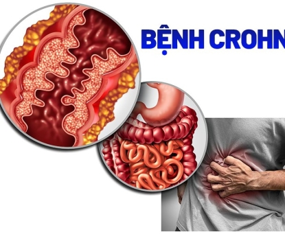 Tổng quan về bệnh Crohn
