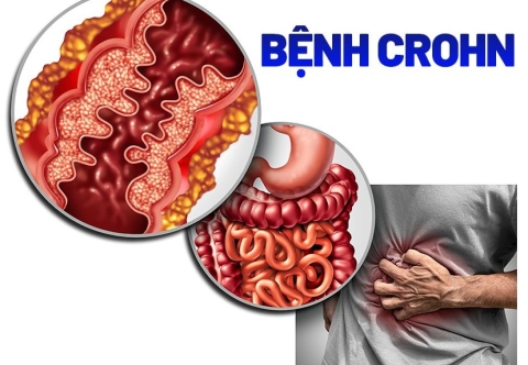 Tổng quan về bệnh Crohn