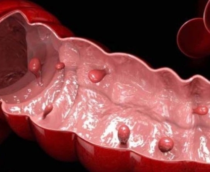 Polyp đại tràng có nguy hiểm không