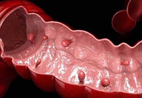 Polyp đại tràng có nguy hiểm không
