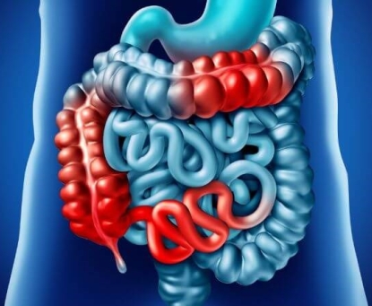 Giới thiệu về bệnh tắc ruột