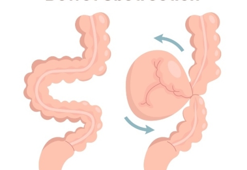 Phương pháp chẩn đoán tắc ruột là gì?