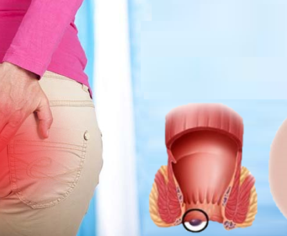 Bệnh trĩ có lây không?