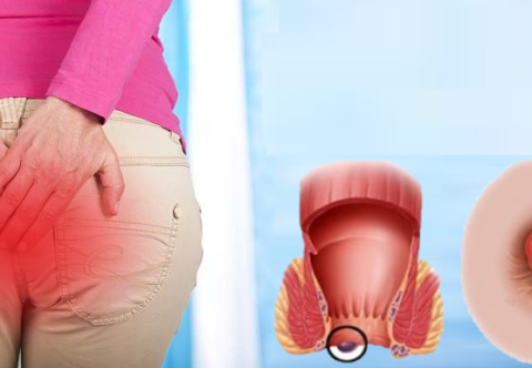 Bệnh trĩ có lây không?