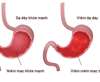 Các dấu hiệu sớm bệnh viêm dạ dày