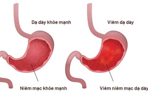 Triệu chứng nhận biết sớm bệnh viêm dạ dày