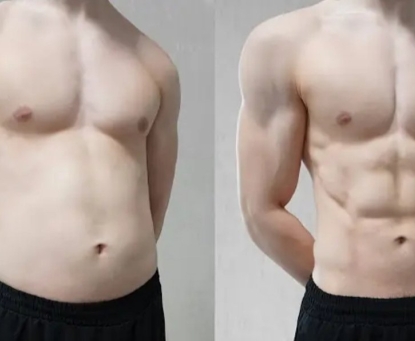 Hậu quả khi kỳ vọng quá cao sau phẫu thuật nội soi thu nhỏ dạ dày là gì?