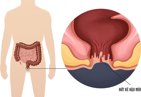Nứt kẽ hậu môn có tự khỏi không, và cách xử lý ban đầu tại nhà