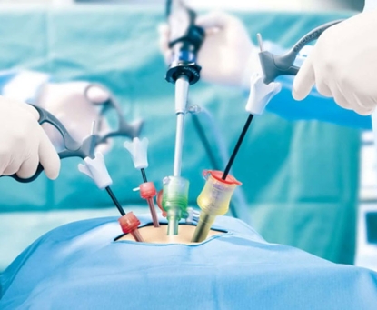 Phẫu thuật cắt ruột thừa nội soi