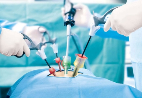 Phẫu thuật cắt ruột thừa nội soi
