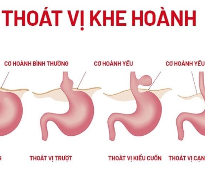 Hướng dẫn chăm sóc sau mổ thoát vị hoành