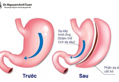 Phẫu thuật nội soi thu nhỏ dạ dày giảm béo: Những điều cần biết