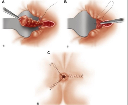 Hướng dẫn chăm sóc sau mổ cắt trĩ bằng phương pháp truyền thống