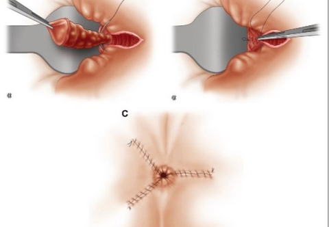 Hướng dẫn chăm sóc sau mổ cắt trĩ bằng phương pháp truyền thống