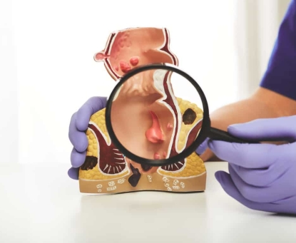 Bệnh trĩ có tự khỏi không, và cách xử lý ban đầu tại nhà