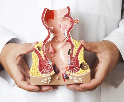 Các phương pháp điều trị bệnh trĩ không cần phẫu thuật