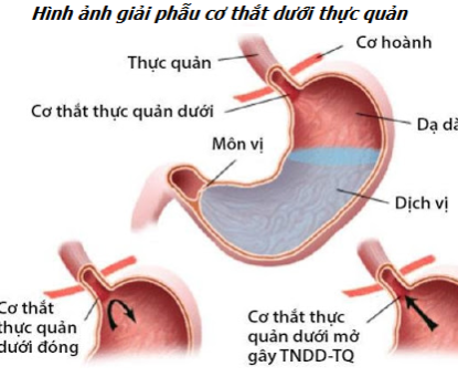 Vì sao suy yếu cơ thắt dưới thực quản lại là nguyên nhân chính gây trào ngược