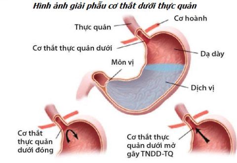 Vì sao suy yếu cơ thắt dưới thực quản lại là nguyên nhân chính gây trào ngược