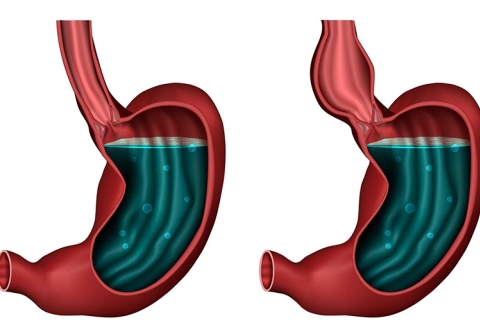Triệu chứng nhận biết sớm bệnh co thắt tâm vị (achalasia)