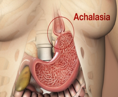 Bệnh co thắt tâm vị có tự khỏi không, cách xử lý ban đầu tại nhà